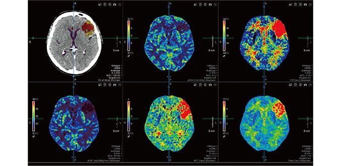 banner-img-EIS-Vitrea-renew_4D-BrainPerfusion.jpeg