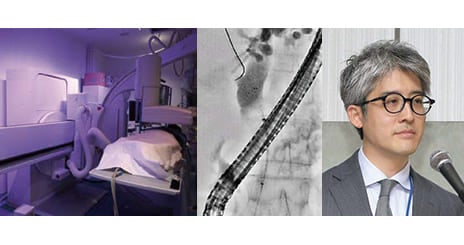 慢性膵炎におけるERCP関連手技をつぎのステージへ