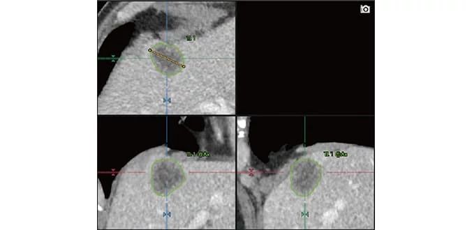 banner-img-EIS-Vitrea-renew_Region-Tracking.jpeg