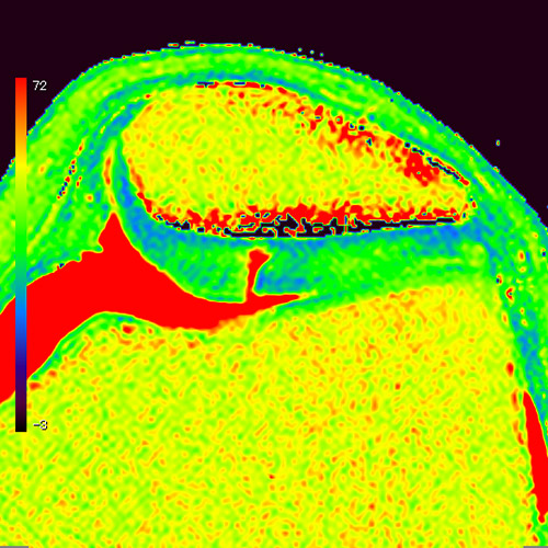 SportsMed Knee MRI 1