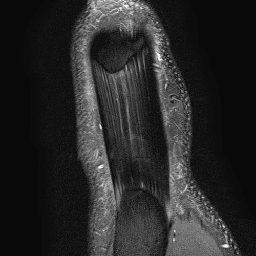 SportsMed Knee MRI // Patellar tendon 1