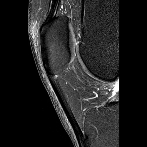 SportsMed Knee MRI // Patellar tendon 2