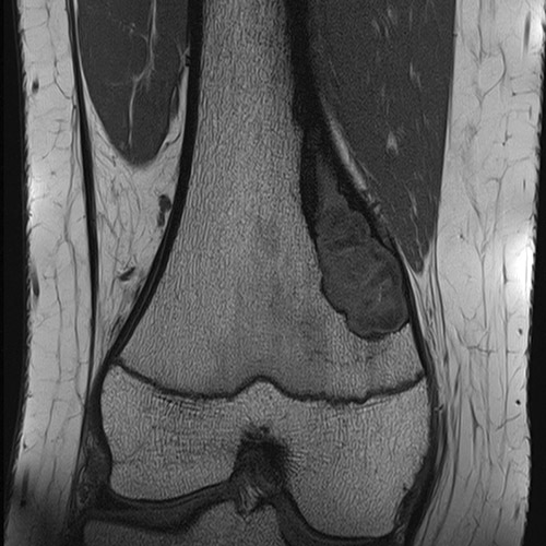 SportsMed Knee MRI // Bone Tumor