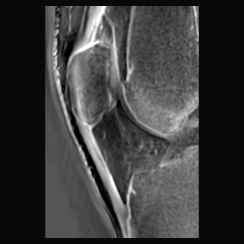 SportsMed Knee MRI // Patellar tendon 2