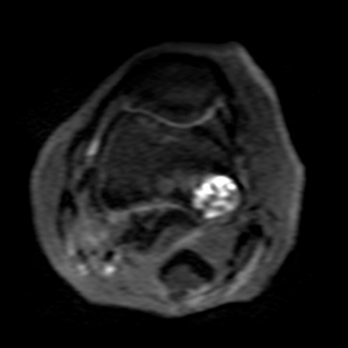 SportsMed Knee MRI // Bone Tumor