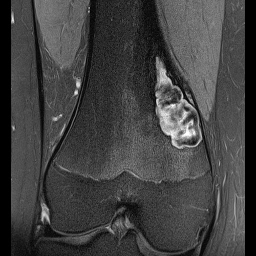 SportsMed Knee MRI // Bone Tumor