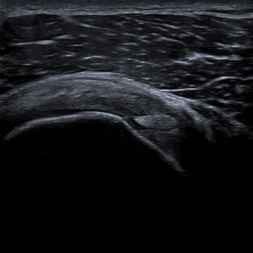 SportsMed Shoulder Supra Spinatus tendon 2
