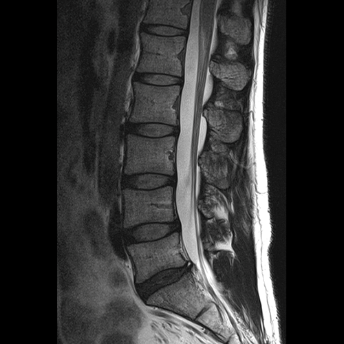SportsMed Spine MRI // L-Spine