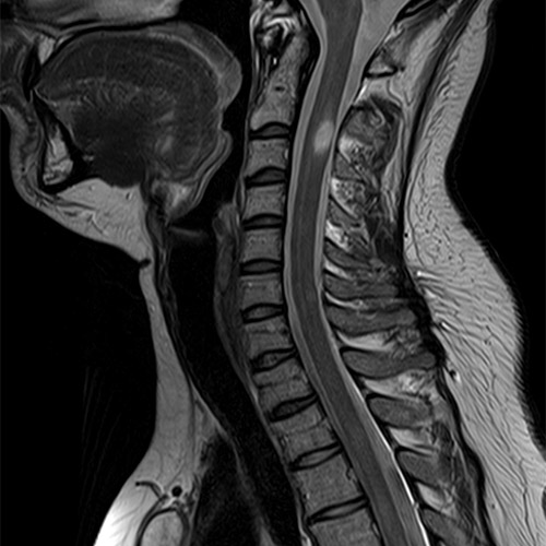 SportsMed Spine MRI // C-Spine 1