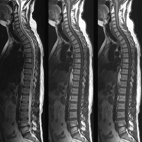 SportsMed Spine MRI // Whole Spine