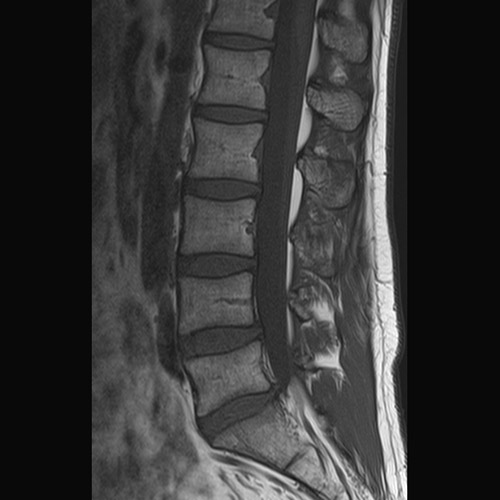 SportsMed Spine MRI // L-Spine
