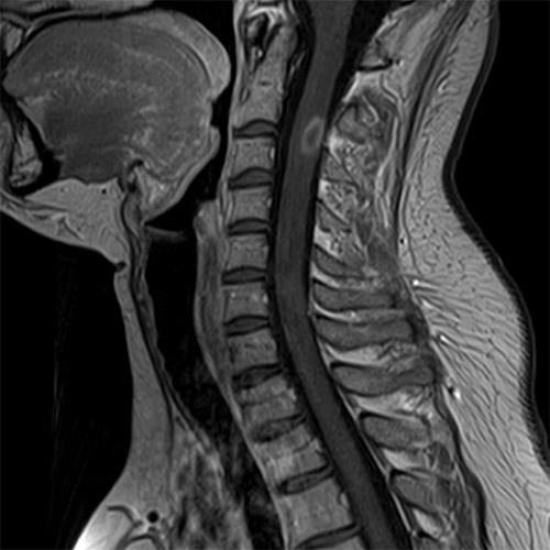 SportsMed Spine MRI // C-Spine 1