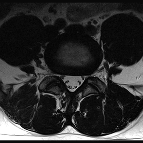 SportsMed Spine MRI // L-Spine