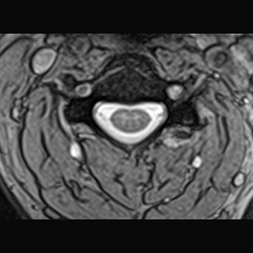 SportsMed Spine MRI // C-Spine 2