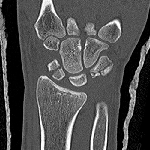 SportsMed Wrist CT