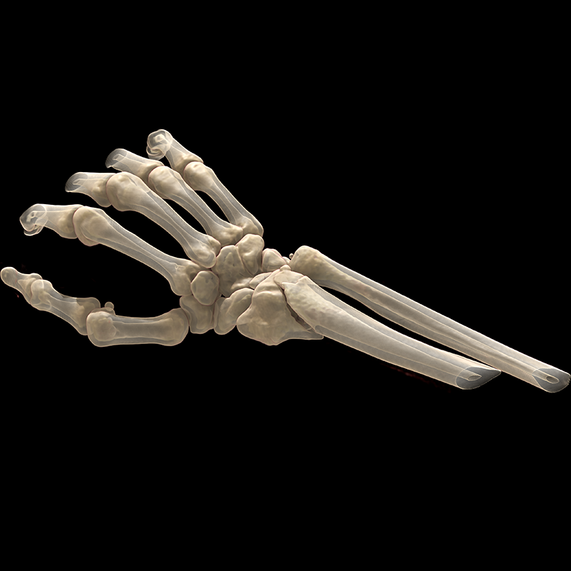 SportsMed Wrist CT// Colles fracture