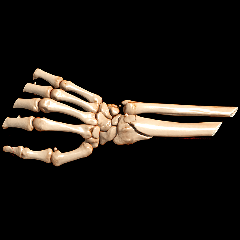 SportsMed Wrist CT// Colles fracture