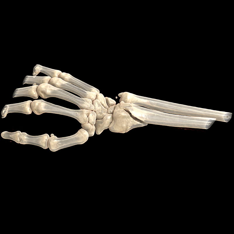 SportsMed Wrist CT// Colles fracture