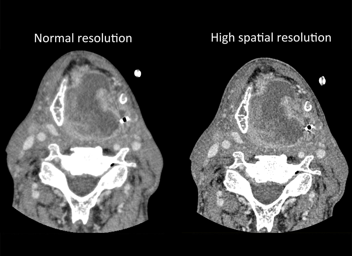Photon Counting CT Head & Neck