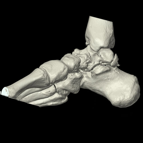 SportsMed Ankle CT