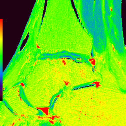 SportsMed Ankle MRI // T2 mapping