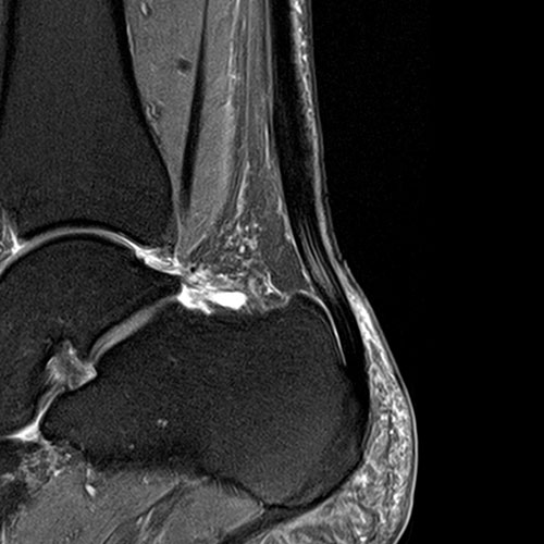 SportsMed Ankle MRI 1