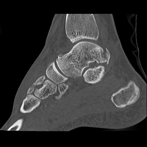 SportsMed Ankle CT