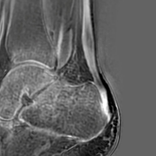SportsMed Ankle MRI 1