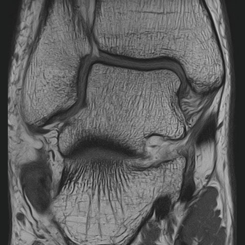 SportsMed Ankle MRI 2