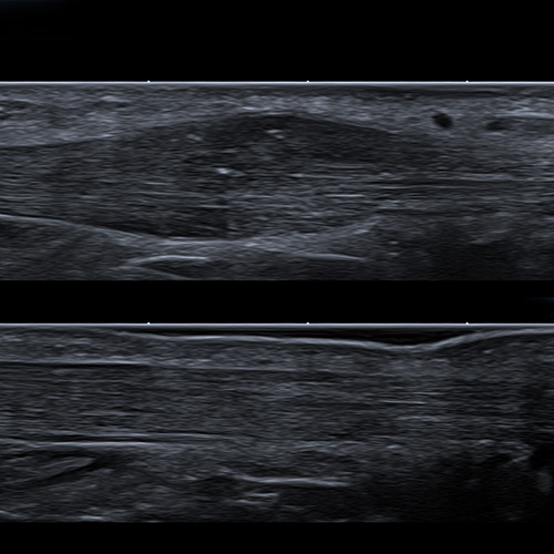 SportsMed Ankle Ultrasound // Achilles Tendinopathy, R & L Comparison