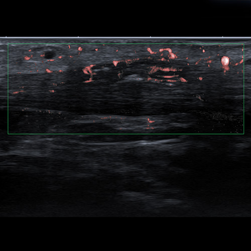 SportsMed Ankle Ultrasound // Achllies Tendon with SMI