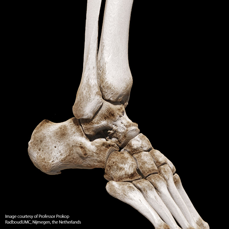 SportsMed Ankle CT// Ankle injury