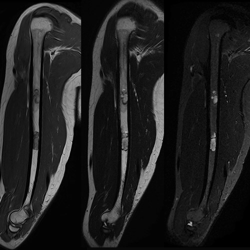 SportsMed Arm MRI
