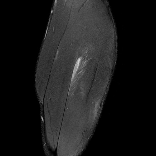 SportsMed Calf MRI