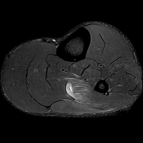 SportsMed Calf MRI