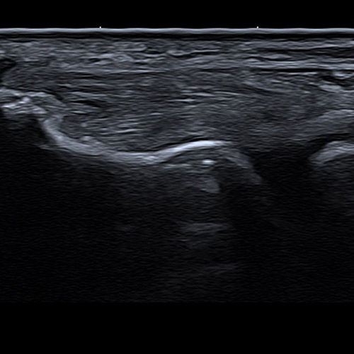 SportsMed Elbow Ultrasound // Lateral Epicondyle 1