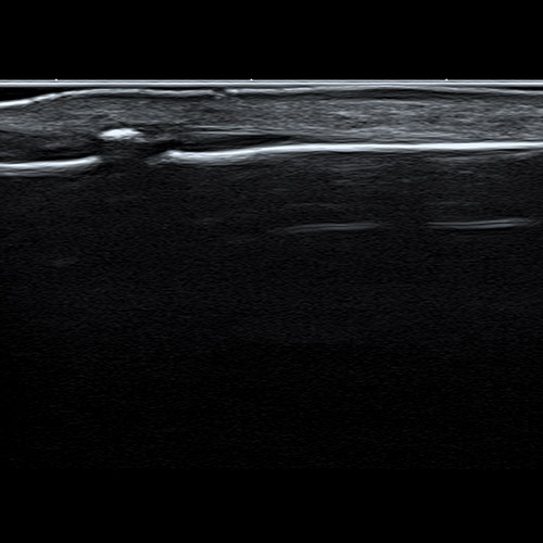 SportsMed Hand Ultrasound // Right ring finger