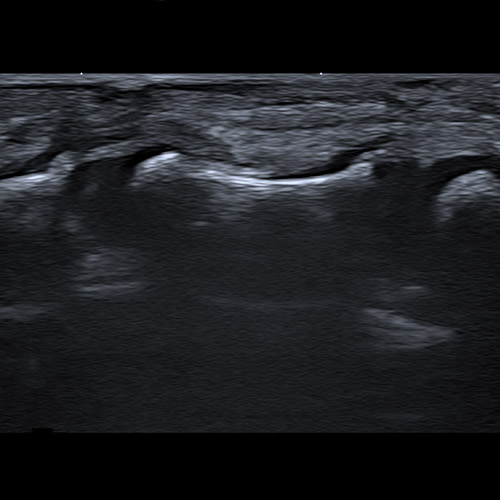 SportsMed Hand Ultrasound // Pediatric Digital nerve