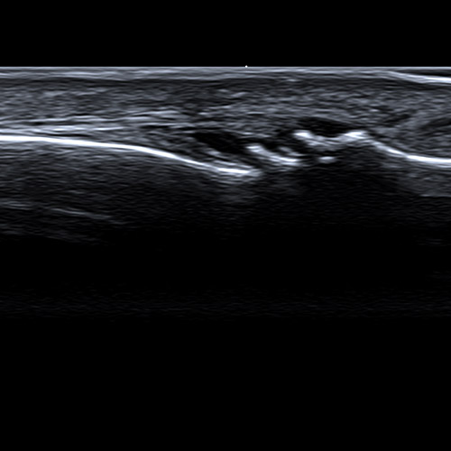 SportsMed Hand Ultrasound // Heberden's nodes 1