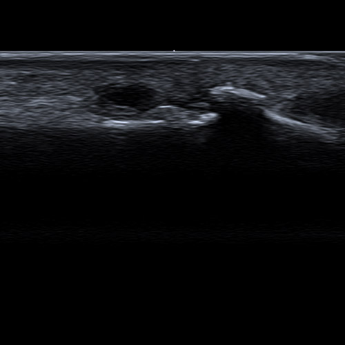 SportsMed Hand Ultrasound // Heberden's nodes 2