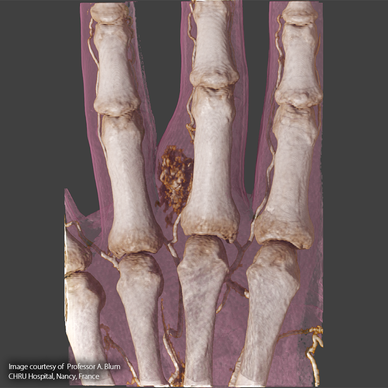 SportsMed Hand CT// Vascular malformation