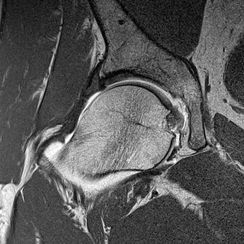 SportsMed Hip MRI // Hip Arthrography