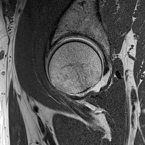 SportsMed Hip MRI // Hip Arthrography