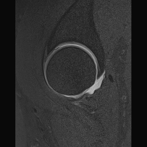SportsMed Hip MRI // Hip Arthrography