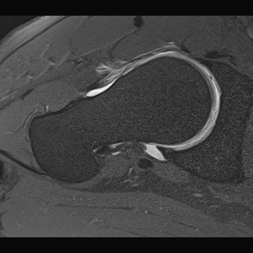 SportsMed Hip MRI // Hip Arthrography