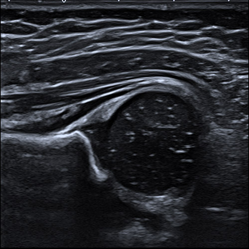 SportsMed Hip Ultrasound