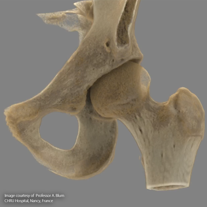 SportsMed Hip CT// Osteomyelitis