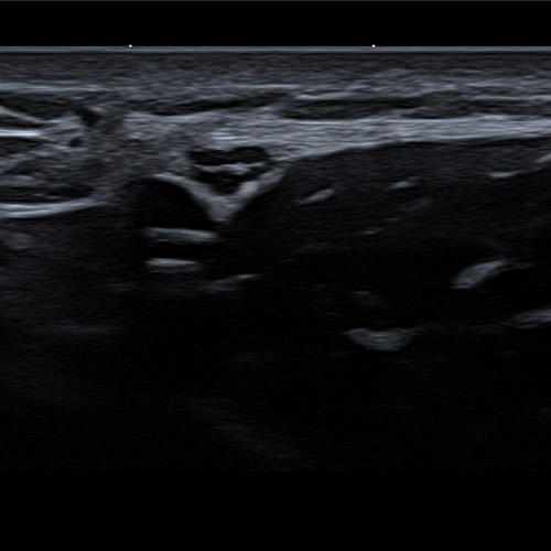 SportsMed Shoulder Brachial Nerve