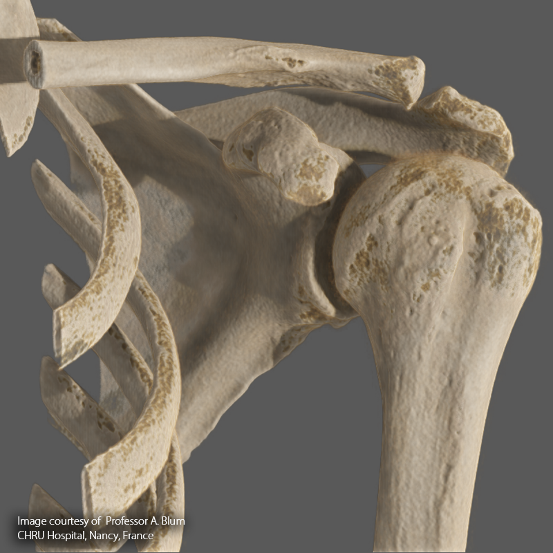 SportsMed Shoulder CT// Enchondroma