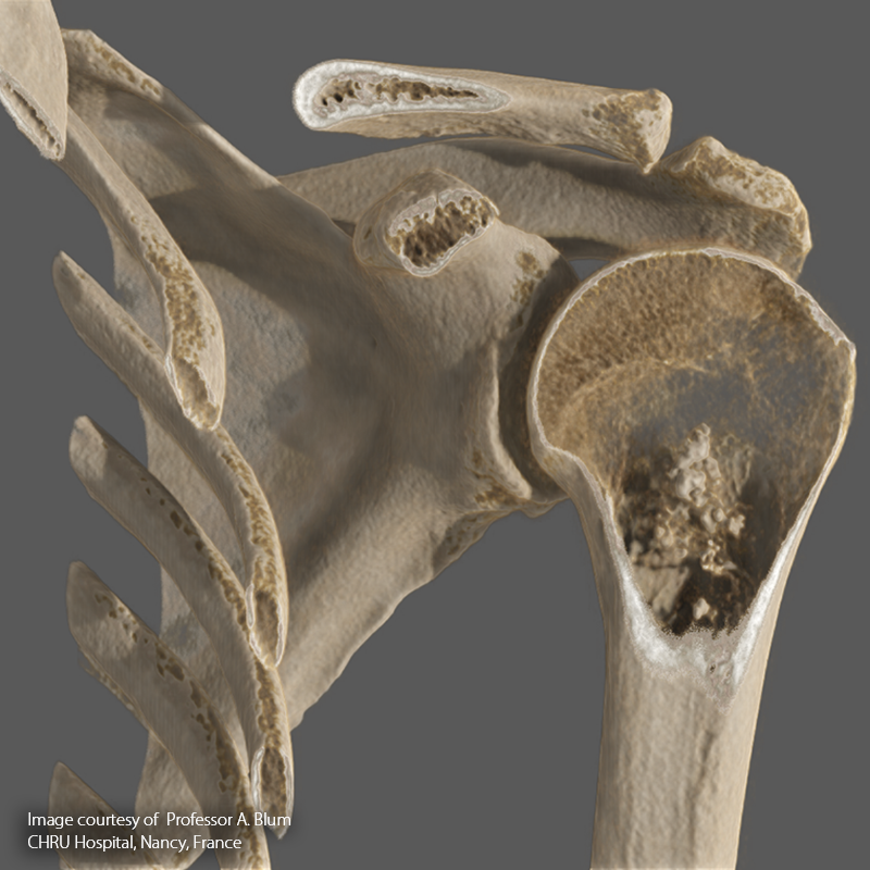 SportsMed Shoulder CT// Enchondroma